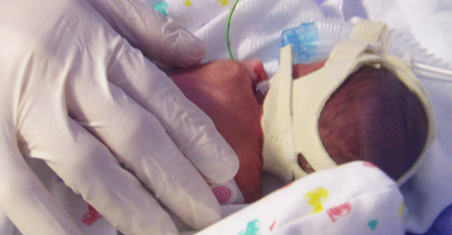 Tiny, fragile Dagen Pratt shortly after birth at Duke University Hospital. (Photo: courtesy Pratt family)